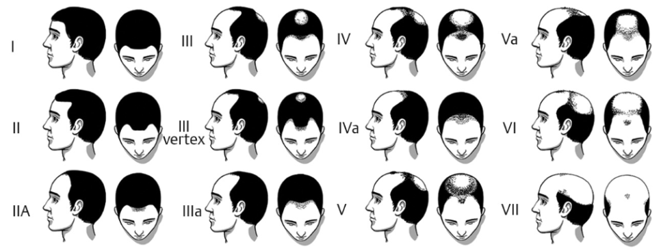 왜 앞머리부터 빠질까? 남성형 탈모 원인과 진행 패턴의 구조 4 image 35