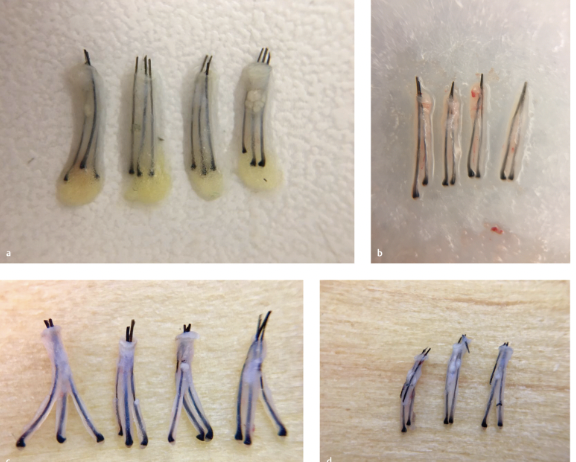 좋은 모발이식 graft란 무엇일까? 2 image 5