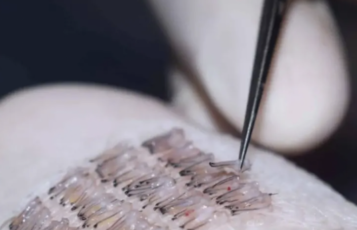 모발이식 밀도는 어떻게 결정될까? 1 image