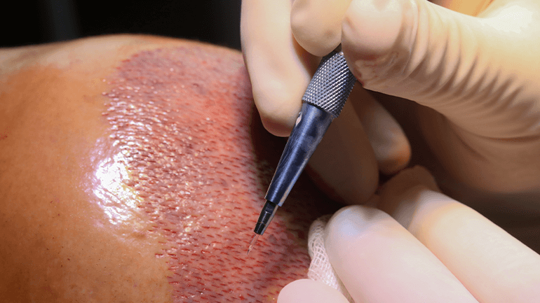 모발이식 슬릿 설계와 결과의 관계 2 image 1