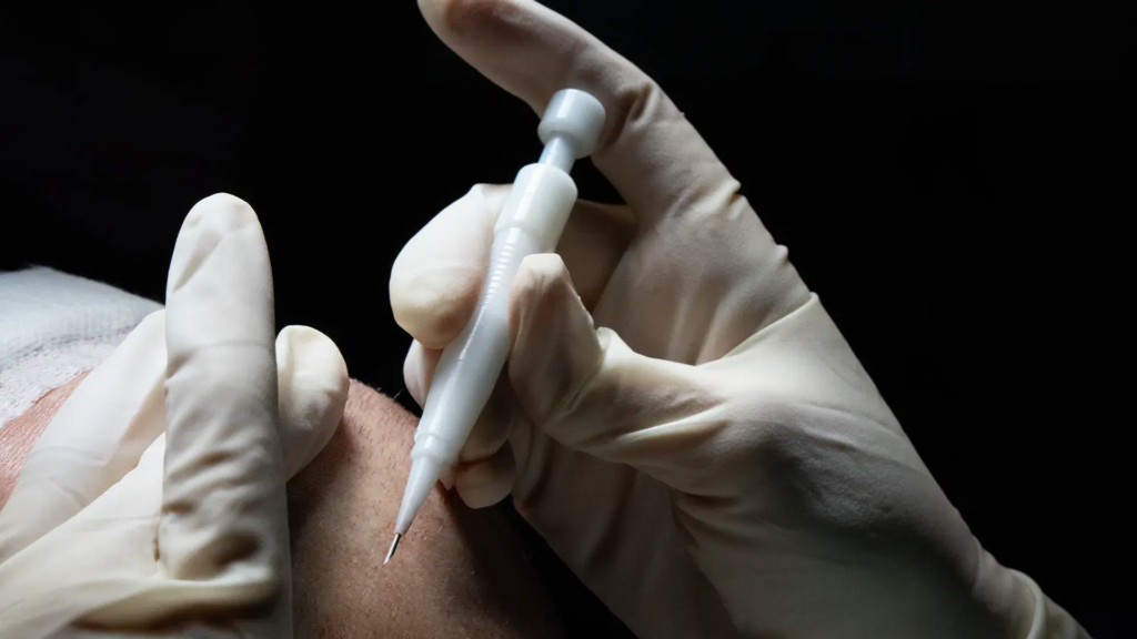 모발이식 슬릿 설계와 결과의 관계 3 image 3