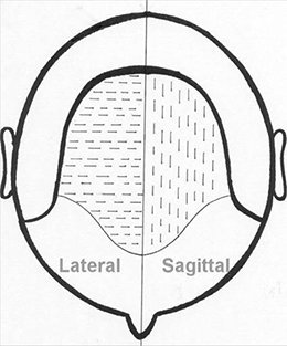 모발이식 슬릿 설계와 결과의 관계 1 image