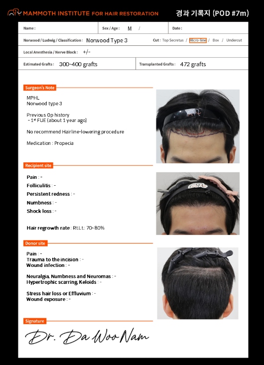 인천 비절개모발이식 밀도 보강 재수술 7개월 후기 3 image 9