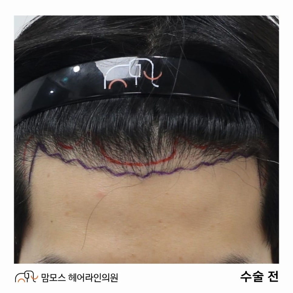 인천 비절개모발이식 밀도 보강 재수술 7개월 후기 1 image