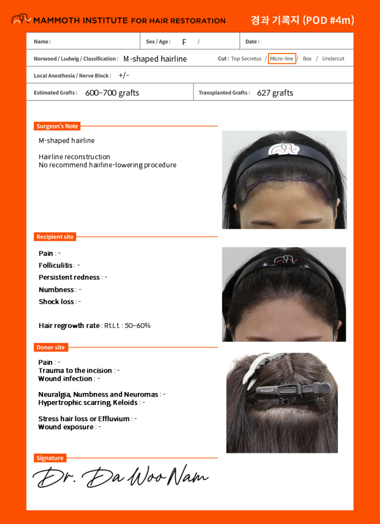 인천 비절개모발이식, 여자 잔머리유지 M자 헤어라인 최종 후기 3 ㅇㅅ 4개월 경과기록지