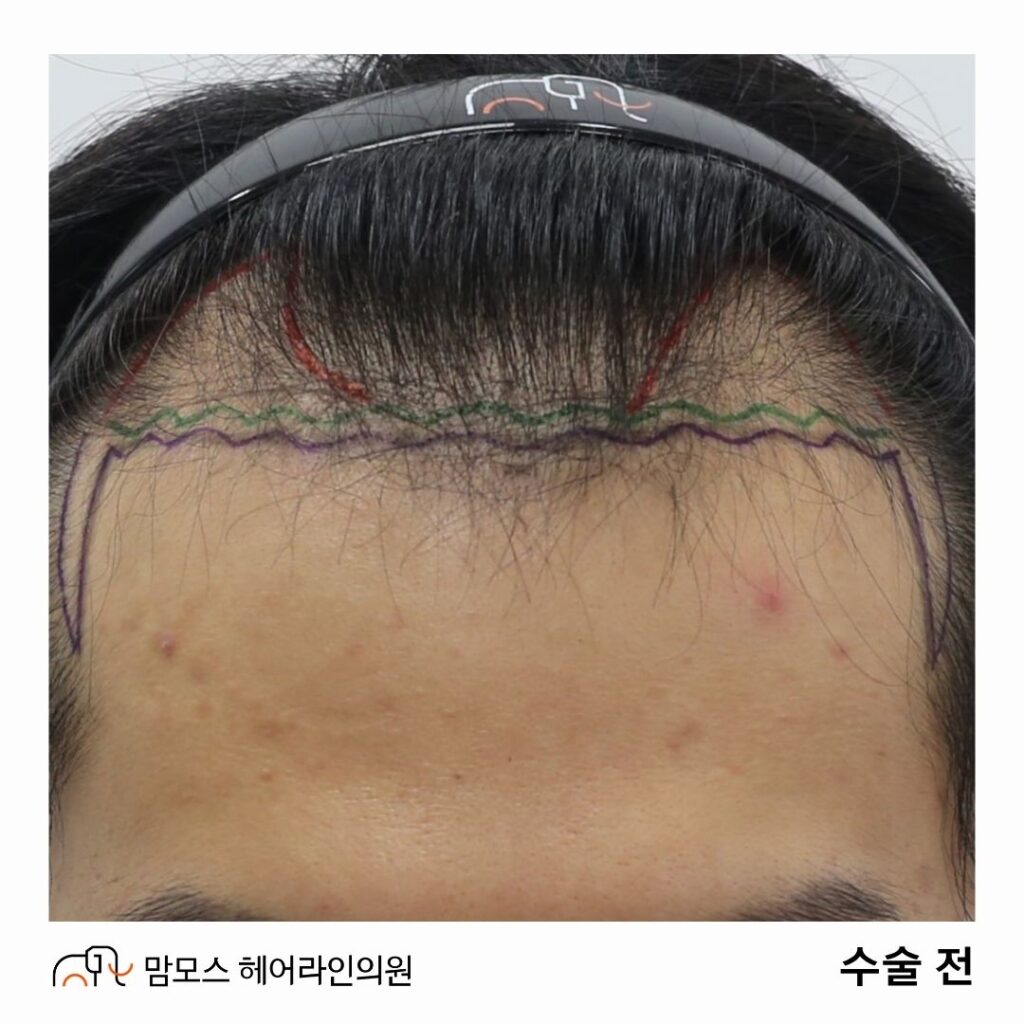인천 모발이식, 20대 남성 비절개 슬릿 방식 디자인과 기록 1 블로그 15