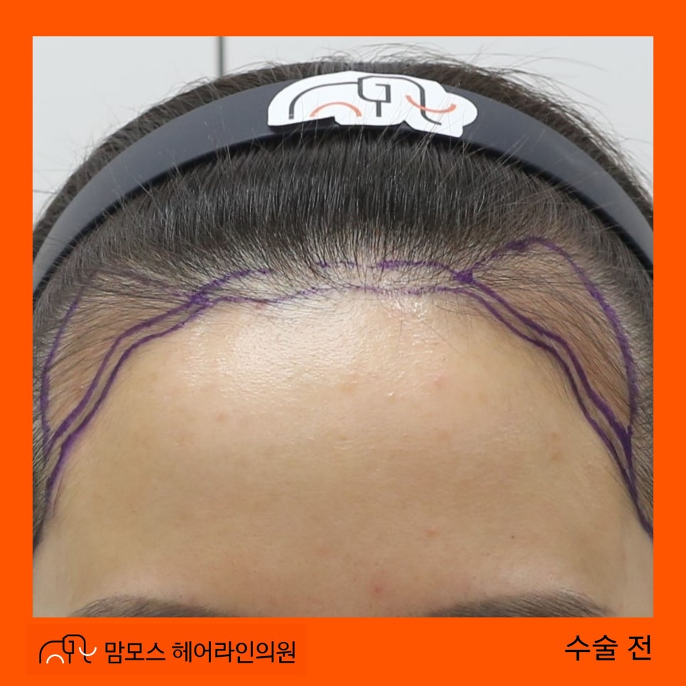 인천 비절개 모발이식, 20대 여성 M자 헤어라인 교정 디자인과 수술 기록 1 블로그 16