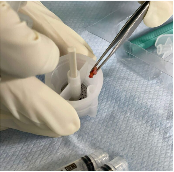 리제네라 액티바(Regenera Activa), 정말 효과 있을까? 2026 최신 메타분석으로 살펴본 탈모 치료의 가능성 5 image 18