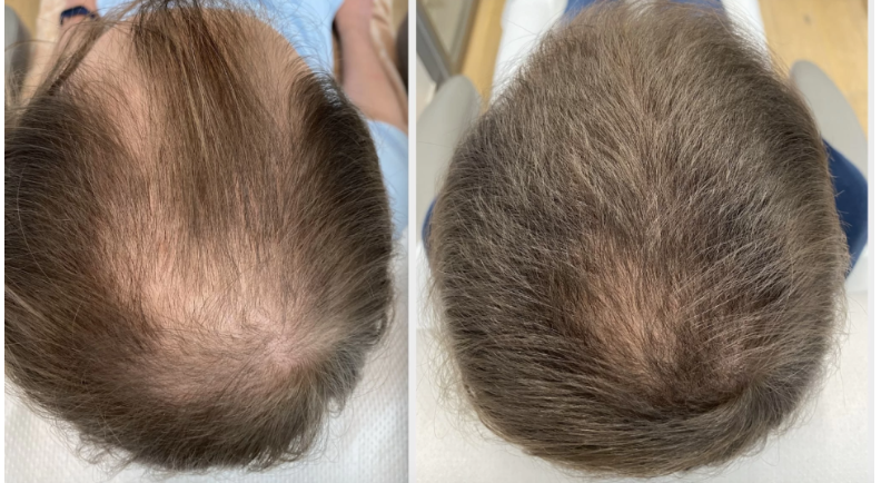 리제네라 액티바(Regenera Activa), 정말 효과 있을까? 2026 최신 메타분석으로 살펴본 탈모 치료의 가능성 3 image 21