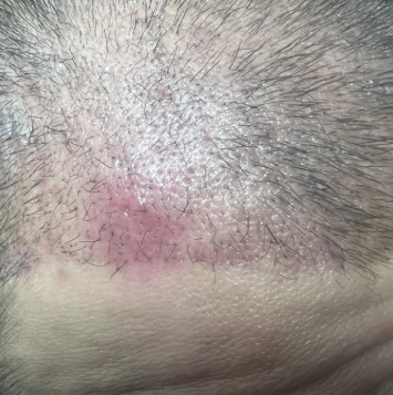 모발이식 암흑기, 언제 시작되고 언제 끝날까? 시기와 회복 과정 총정리 5 image 20
